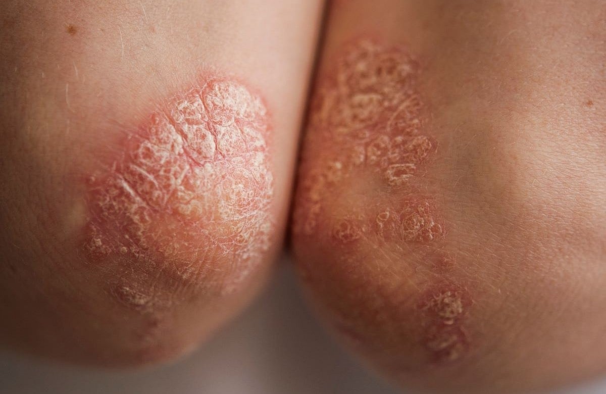 Nueva píldora podría cambiar el tratamiento de la psoriasis